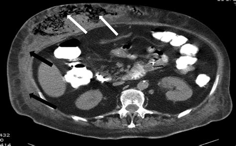 Abdominal Wall Necrotising Fasciitis Due To Dislodged Percutaneous