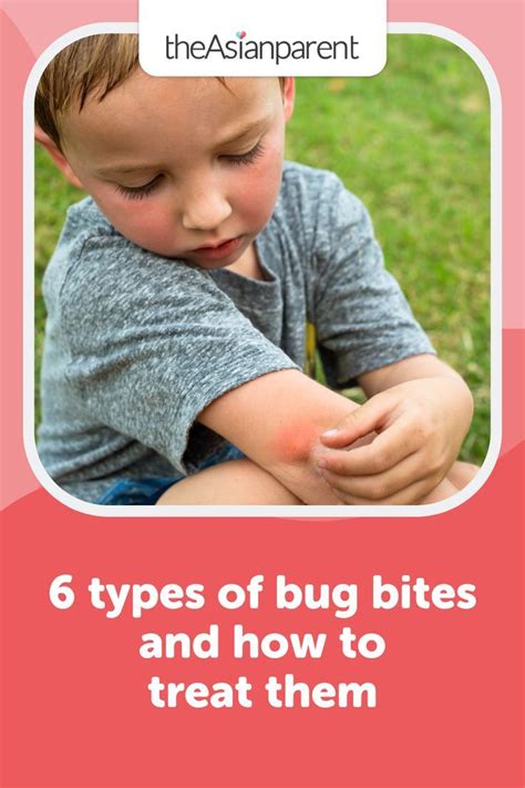 6 Types Of Bug Bites And How To Treat Them In 2022 Types Of Bug Bites