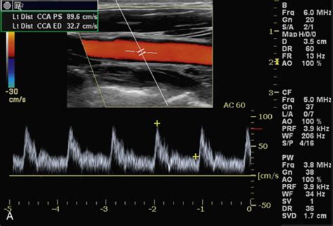 Doppler Flow Imaging And Spectral Analysis Radiology Key