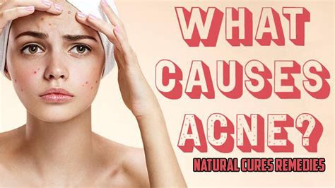 What Causes Acne Loan Nguyen Acne Treatment Acne Treatment Youtube