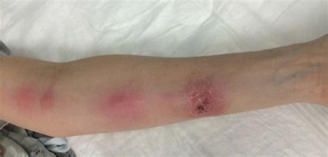 Ascending Erythematous Nodules On The Arm Mdedge Dermatology