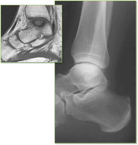 Avascular Necrosis Of The Talus Radrounds Radiology Network