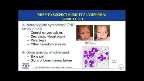 Diagnosis And Referral Of Burkitts Lymphoma 3 February 2023 Youtube