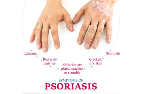 Symptoms Of Psoriasis