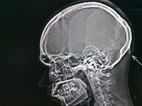 Prominent External Occipital Protuberance Radiology