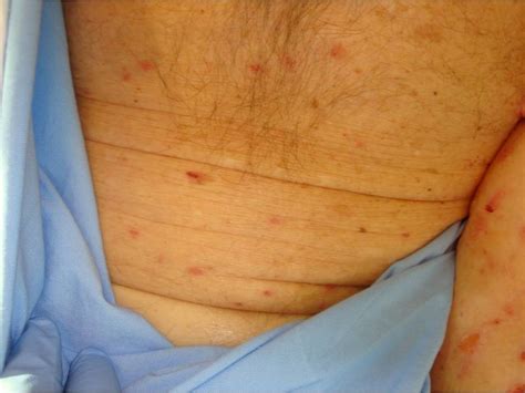 El herpes zoster puede ocurrir en personas vih+ poco tiempo después de que comienzan a tomar tratamiento antirretroviral. Consultations in Dermatology: A Painful Rash - Herpes Zoster