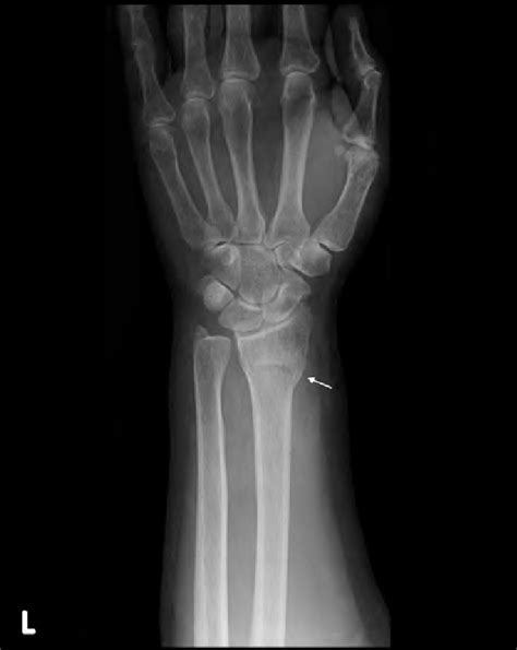 Ulna Styloid And Shaft Fractures Image Radiopaediaorg