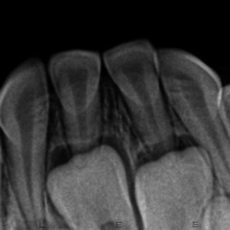 Preoperative Radiograph Of The Region Showing Slight Radiolucency