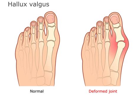 Bunions Mobile Podiatry Nyc Foot And Ankle Care In New York City