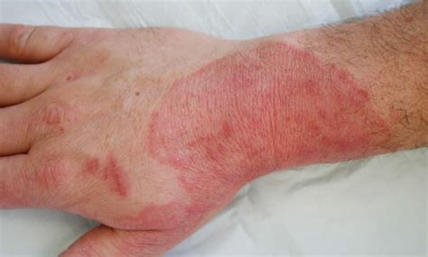 Yeast Fungal Skin Infection Skin Infection Pictures And Treatments