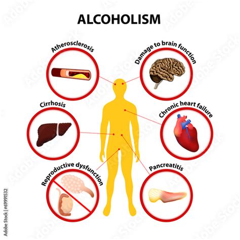 Alcoholism Infographic Stock Illustration Adobe Stock