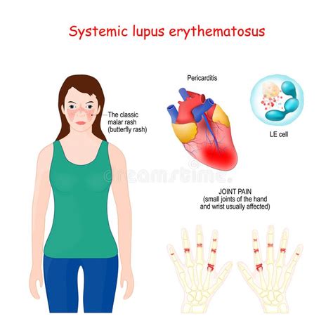 Allergic Rhinitis Medical Diagram Vector Illustration Labeled