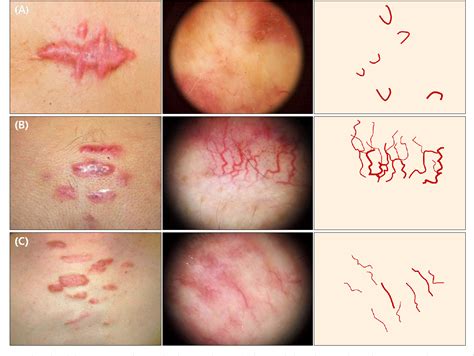 PDF Keloids And Hypertrophic Scars Characteristic Vascular Structures Visualized By Using