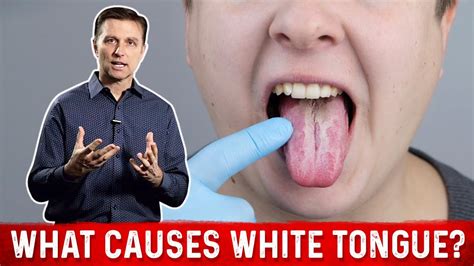 What Causes White Tongue Drberg On Oral Candidiasis Youtube