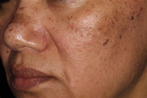 Skin Pigmentation Results Environ Skin Care South Africa