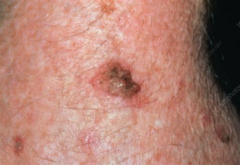 A Solar Keratosis Found On An Elderly Person Stock Image M1900019