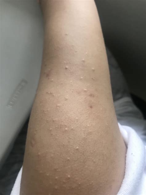Skin Concern There Are White Bumps On My Both My Arms And My