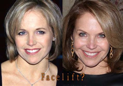 katie couric plastic surgery before and after top cel