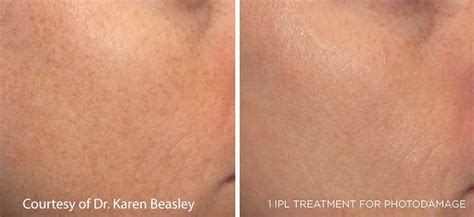 Ipl Photorejuvenation Maryland Dermatology Laser Skin And Vein
