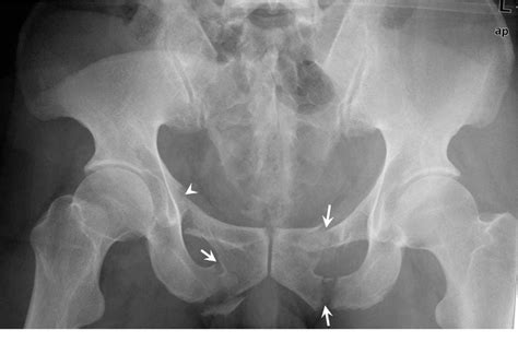 Superior and inferior pubic rami fracture - NISHIOHMIYA ...