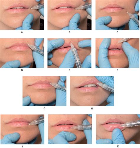 Chapter 16 Filler Injection Of The Lips Oral Commissure And Mentolabial Plastic Surgery Key