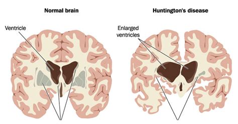 Huntingtons Disease The Brain Clinic