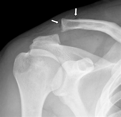 Imaging Of The Acromioclavicular Joint Anatomy Function Pathologic Features And Treatment