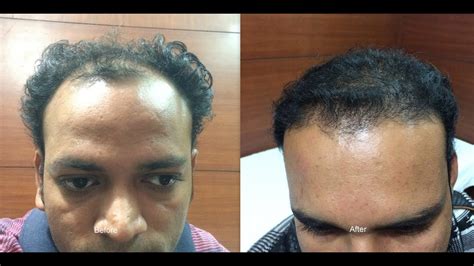 Hair Transplantation Follicular Unit Extraction Fue Youtube