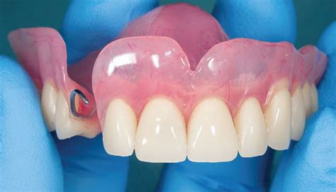 Care Strategies For Removable Dental Prostheses Decisions In Dentistry
