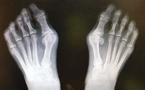 Pros And Cons Of Big Toe Fusion