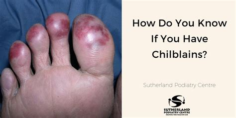How Do You Know If You Have Chilblains Sutherland Podiatry