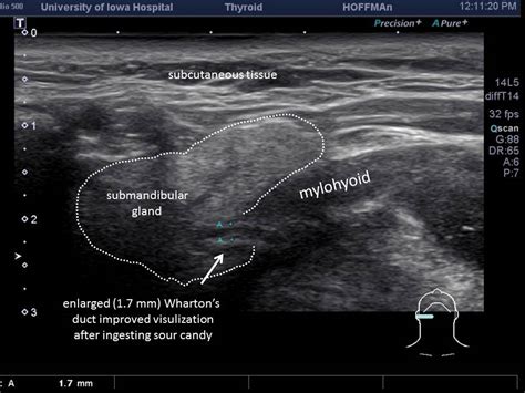 Salivary Gland Ultrasound Anatomy Images And Photos Finder