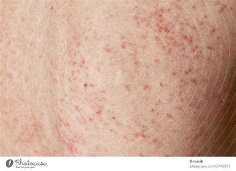 Allergic Rash On Skin Woman With Dermatology Problem On Back Skin A