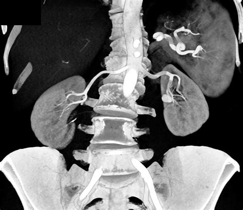 Stone In Inflamed Left Renal Pelvis Kidney Case Studies Ctisus Ct