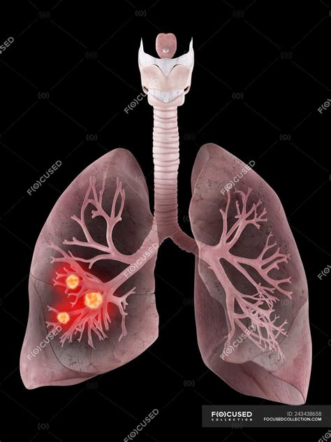 Illustration Of Human Lungs And Bronchi Cancer — Anatomy Health