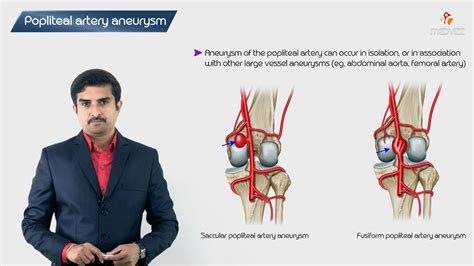 Popliteal Aneurysm Surgery How It Works Recovery