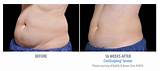 Coolsculpting Side Effects Long Term Images