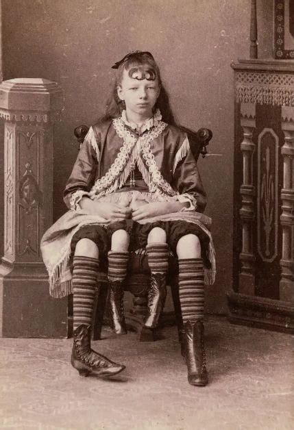 True Story Of Josephine Myrtle Corbin The Lady Born With Four Legs