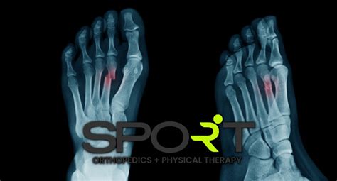 Pinned Foot Bone Fracture X Ray Photograph By Miriam Maslo Fine Art