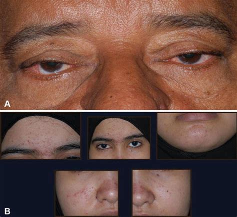 Rhinophyma Is Pathological Hypertrophy Of Sebaceous Gland Of The Nose