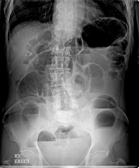 The Abdominal Xray A Relic Or A Reliable Tool — Taming The Sru