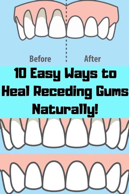 10 Easy Ways To Heal Receding Gums Naturally Info Remedies
