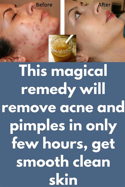 this magical remedy will remove acne and pimples in only few hours get smooth clean skin