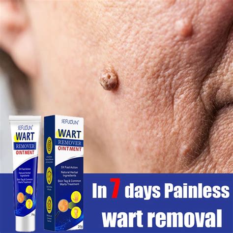 20g Sefudun Warts Remover Cream Warts Magic Remover Wart Treatment