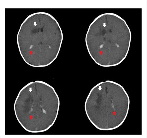 Figure E Brain Computed Tomography Revealed Subarachnoid Hemorrhage