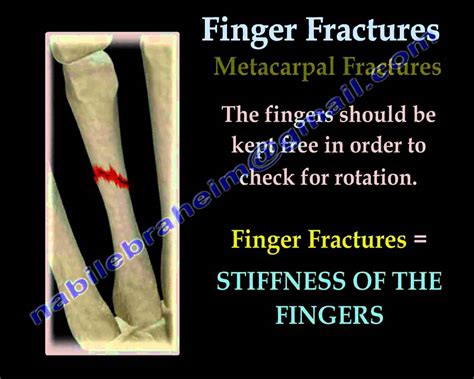 Ongoing stiffness, aching or disability.stiffness, pain or aching in the affected area generally goes away eventually after your cast is removed or after surgery. Finger and metacarpal Fractures - Everything You Need To ...