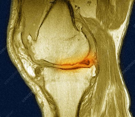 Knee Arthritis Mri Stock Image C0271376 Science Photo Library