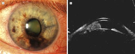 Neovascular Glaucoma Anatomi