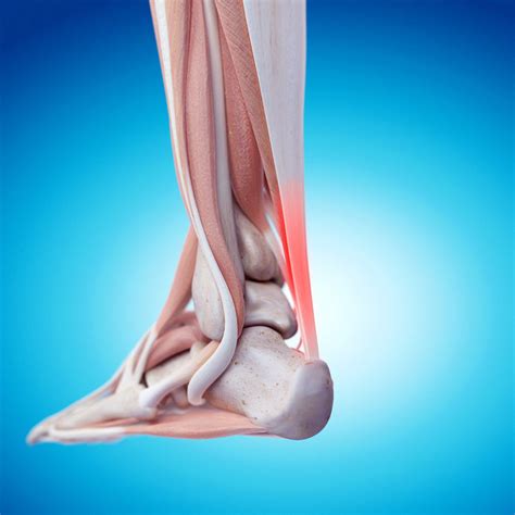 Achilles Tendonitis Treatments Remedies And Important Information