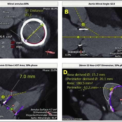 Inspiris Resilia Aortic Bioprosthetic Valve Edwards Lifesciences